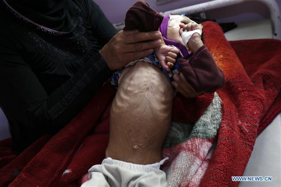 YEMEN-SANAA-CHILDREN-MALNUTRITION
