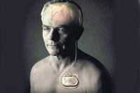 【健康解碼】起搏器真的能治好帕金森病嗎？